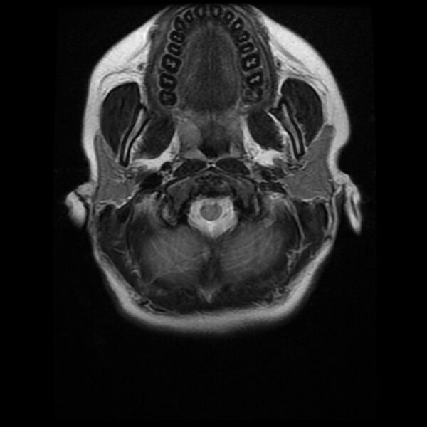 File:Cerebral cavernous malformation (Radiopaedia 44301-47942 Axial T2 2).jpg