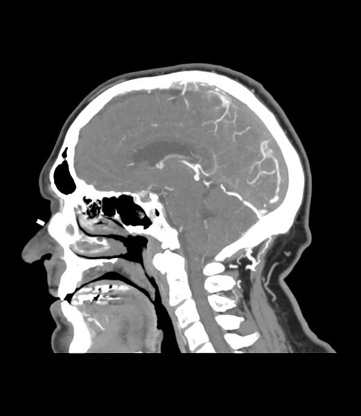 File:Cerebral dural venous sinus thrombosis (Radiopaedia 86514-102576 C 25).jpg