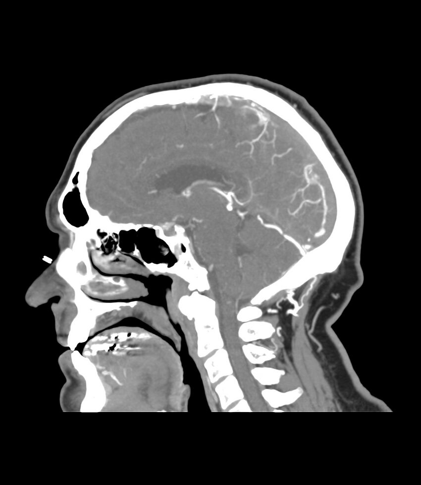 Cerebral dural venous sinus thrombosis (Radiopaedia 86514-102576 C 25).jpg