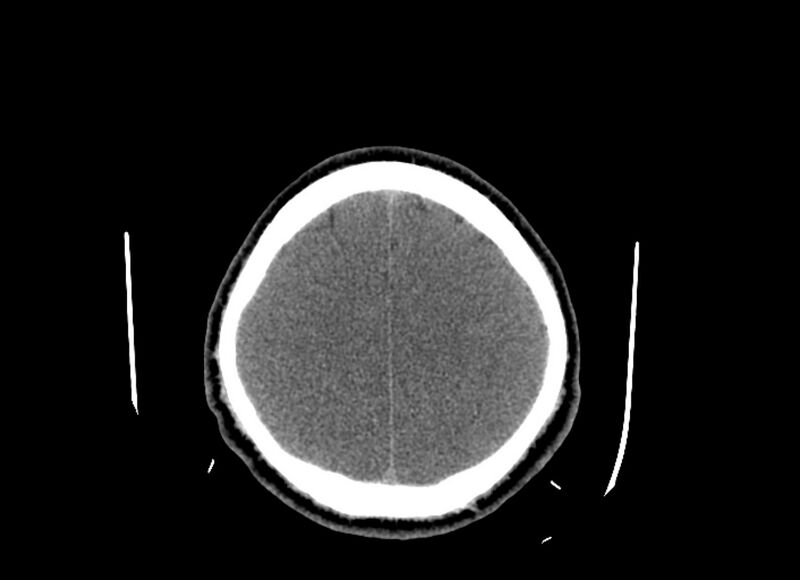 File:Cerebral edema (Radiopaedia 82519-96661 Axial non-contrast 14).jpg