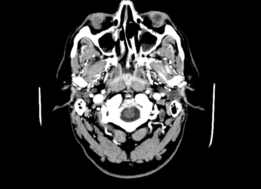 Cerebral edema (Radiopaedia 82519-96661 B 55).jpg