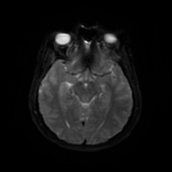 File:Cerebral fat embolism (Radiopaedia 37510-39363 Axial DWI 35).jpg