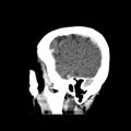 Cerebral hemorrhagic contusions (Radiopaedia 23145-23188 C 7).jpg