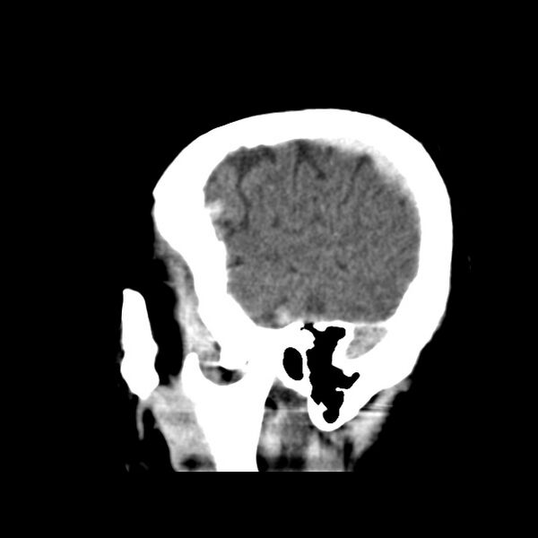File:Cerebral hemorrhagic contusions (Radiopaedia 23145-23188 C 7).jpg