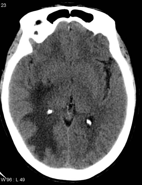 File:Cerebral metastasis - lung cancer (Radiopaedia 5315-7072 Axial non-contrast 2).jpg