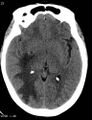 Cerebral metastasis - lung cancer (Radiopaedia 5315-7072 Axial non-contrast 2).jpg