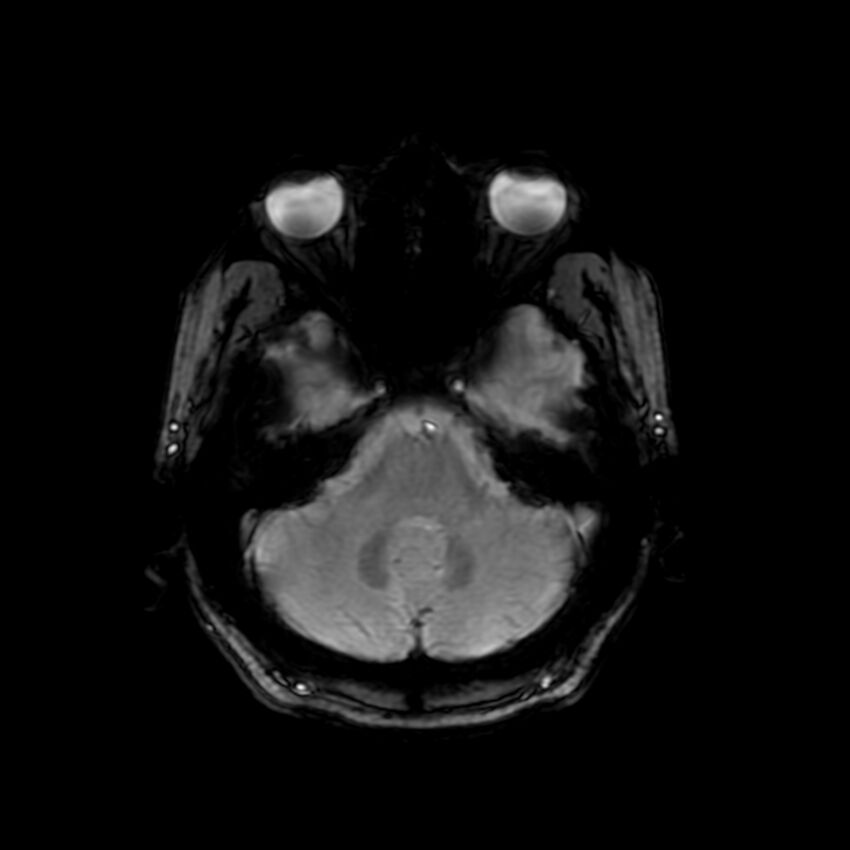 Cerebral paragonimiasis (Radiopaedia 73473-84238 Axial SWI 18).jpg