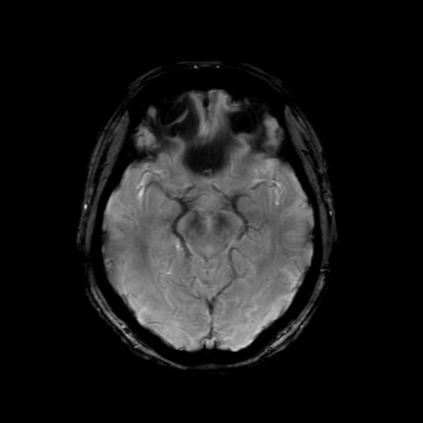 Cerebral paragonimiasis (Radiopaedia 73473-84238 Axial SWI 29).jpg