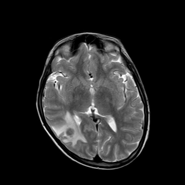 File:Cerebral tuberculoma (Radiopaedia 41152-43932 Axial T2 11).jpg
