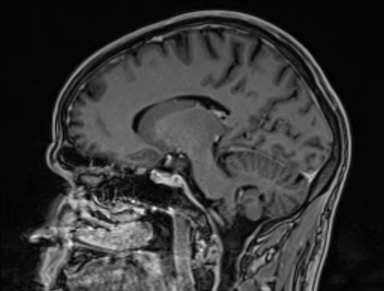 File:Cerebral venous thrombosis (Radiopaedia 71207-81504 Sagittal T1 C+ 25).jpg