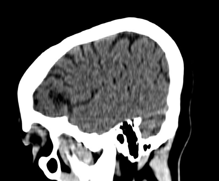 File:Cerebral venous thrombosis - CT only (Radiopaedia 41031-43778 B 4).jpg