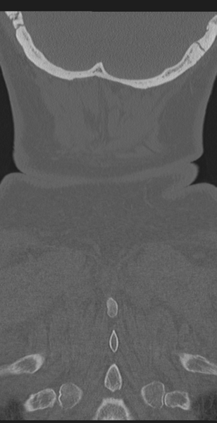 File:Cervical canal stenosis due to ossification of the posterior longitudinal ligament (Radiopaedia 47260-51823 Coronal bone window 65).png