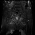 Cervical carcinoma (Radiopaedia 78847-91705 Coronal T2 fat sat 7).jpg
