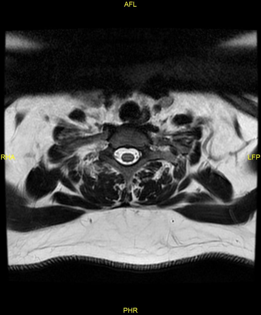 Cervical disc protrusion (Radiopaedia 87147-103415 Axial T2 73).jpg