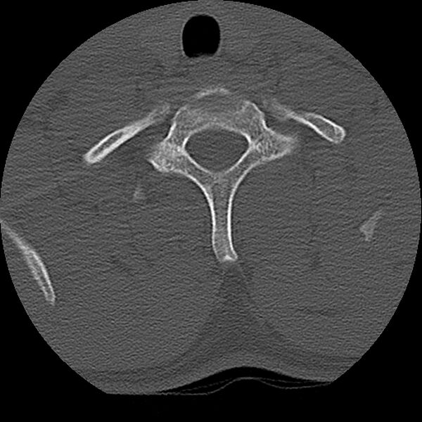 File:Cervical flexion teardrop fracture with cord hemorrhage (Radiopaedia 32497-33454 Axial bone window 74).jpg