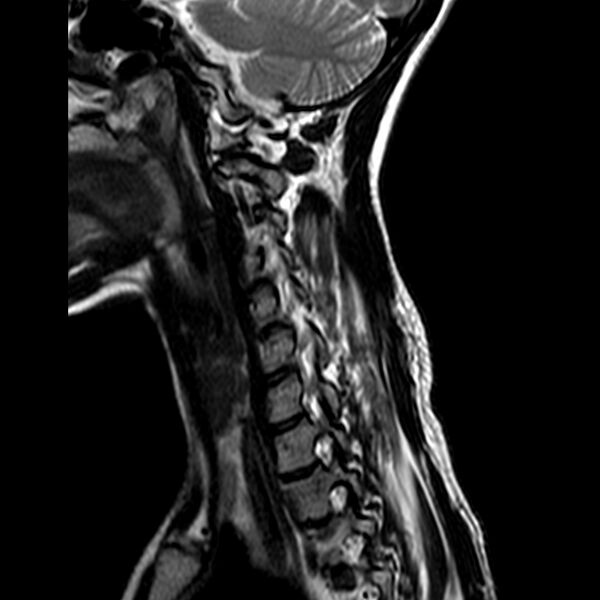 File:Cervical spine posterior ligamentous complex rupture (Radiopaedia 63486-72103 Sagittal T2 3).jpg