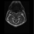 Cervical vertebrae metastasis (Radiopaedia 78814-91667 Axial T1 C+ 15).png