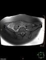 Cesarian scar endometriosis (Radiopaedia 68495-78066 Axial T1 fat sat 1).jpg