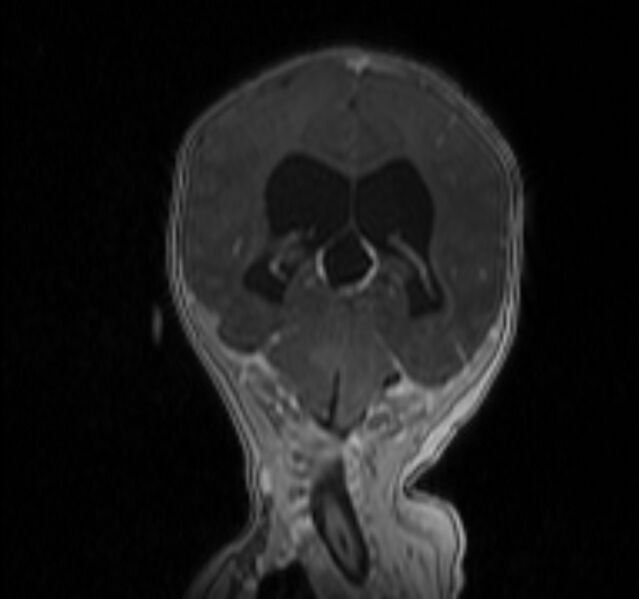 File:Chiari III malformation with occipital encephalocele (Radiopaedia 79446-92559 Coronal T1 C+ mpr 25).jpg