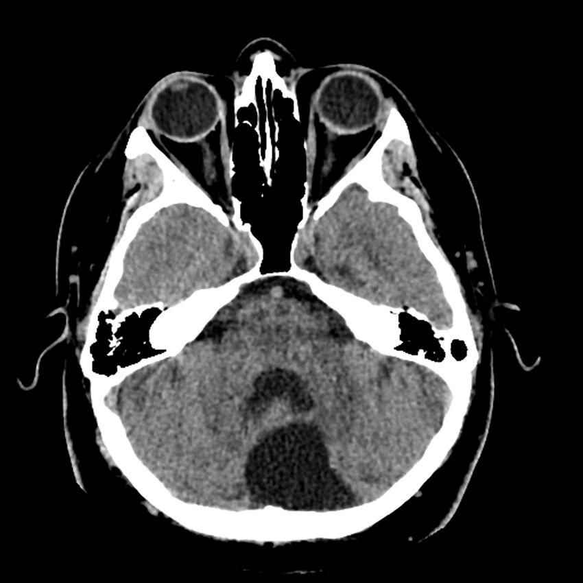 Chiasmatic-hypothalamic juvenile pilocytic astrocytoma (Radiopaedia 78533-91237 Axial non-contrast 18).jpg