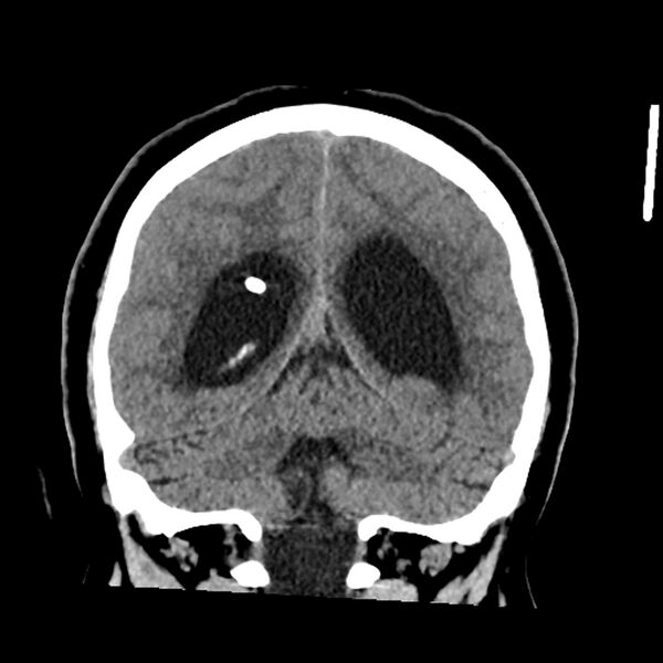File:Chiasmatic-hypothalamic juvenile pilocytic astrocytoma (Radiopaedia 78533-91237 Coronal non-contrast 48).jpg