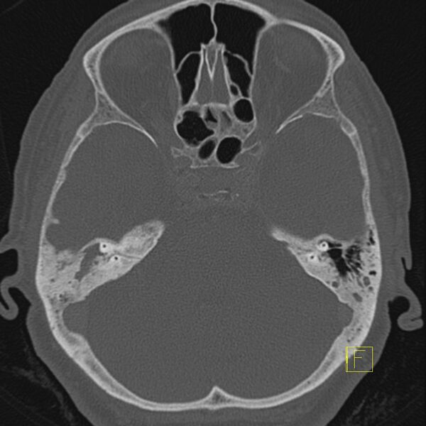 File:Cholesteatomatous chronic otitis (Radiopaedia 14993-14911 Axial bone window 3).JPEG