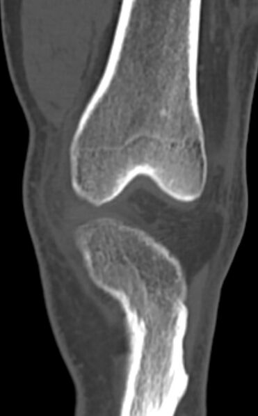 File:Chondrocalcinosis (Radiopaedia 82862-97173 Coronal bone window 25).jpg