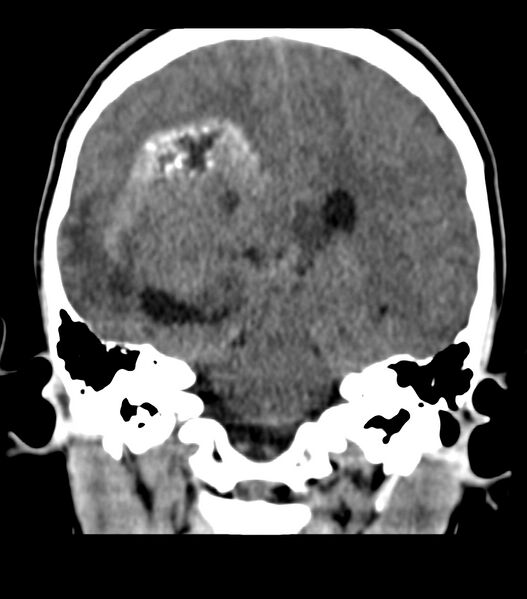 File:Choroid plexus carcinoma (Radiopaedia 91013-108552 Coronal non-contrast 52).jpg