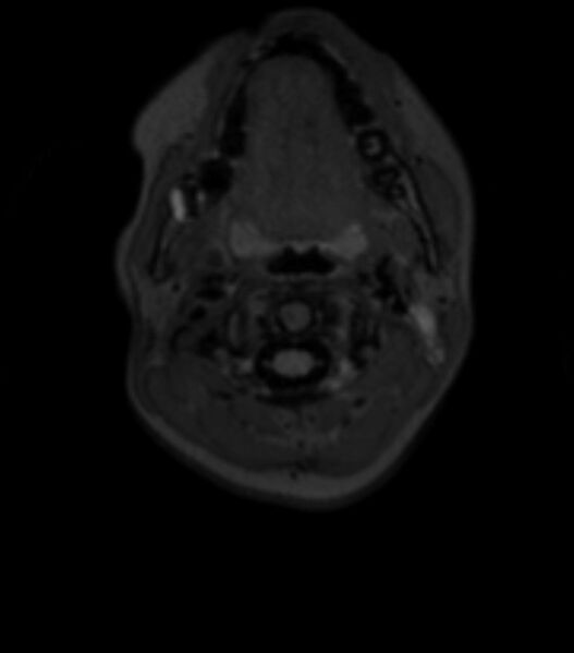 File:Choroid plexus carcinoma (Radiopaedia 91013-108553 Axial T2 fat sat 6).jpg
