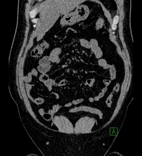 File:Chromophobe renal cell carcinoma (Radiopaedia 84286-99573 Coronal non-contrast 42).jpg