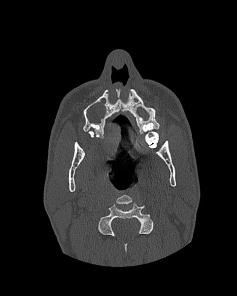 File:Chronic maxillary sinusitis caused by a foreign body (Radiopaedia 58521-65676 Axial bone window 52).jpg