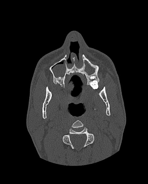 File:Chronic maxillary sinusitis caused by a foreign body (Radiopaedia 58521-65676 Axial bone window 61).jpg