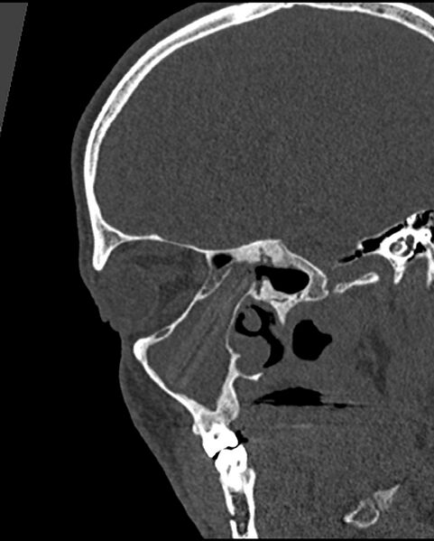 File:Chronic maxillary sinusitis caused by a foreign body (Radiopaedia 58521-65676 Sagittal bone window 30).jpg