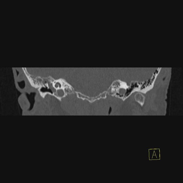 File:Chronic otitis media (Radiopaedia 14994-14912 Coronal bone window 14).JPEG