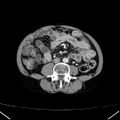 Chronic pancreatitis (Radiopaedia 23132-23172 B 37).jpg