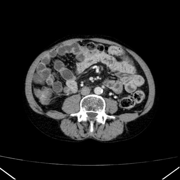 File:Chronic pancreatitis (Radiopaedia 23132-23172 B 37).jpg