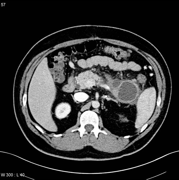 File:Chronic pancreatitis and pseudocysts (Radiopaedia 6724-7935 B 9).jpg