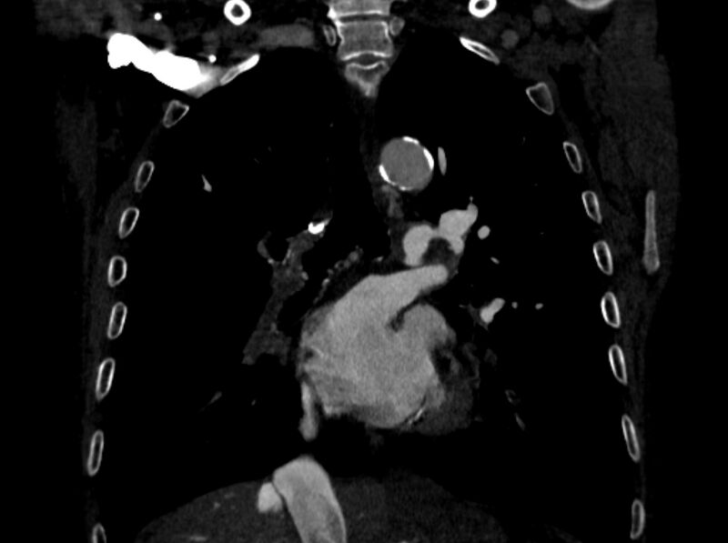 File:Chronic pulmonary embolism (Radiopaedia 91241-108843 A 58).jpg