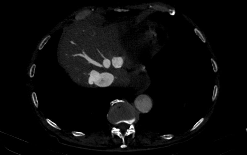 File:Chronic pulmonary embolism (Radiopaedia 91241-108843 B 160).jpg