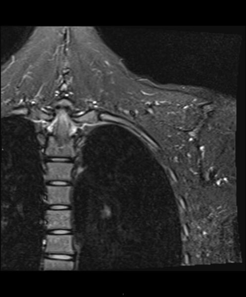 File:Chronic reactive multifocal osteomyelitis (CRMO) - clavicle (Radiopaedia 56406-63114 Coronal STIR 1).jpg
