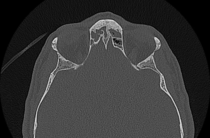 File:Chronic rhinosinusitis (Radiopaedia 65079-74075 Axial bone window 65).jpg