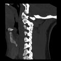 Clay-shoveler fracture (Radiopaedia 22568-22590 Sagittal MIP 15).jpg