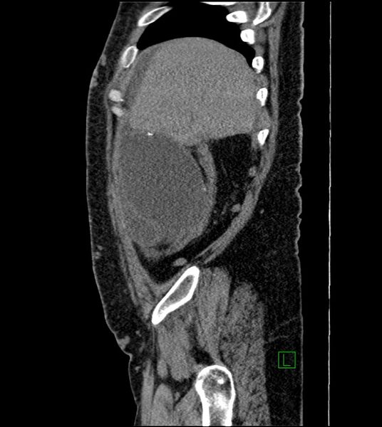File:Closed-loop small bowel obstruction-internal hernia (Radiopaedia 78439-91096 C 120).jpg