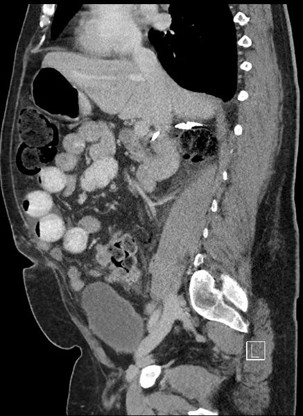 File:Closed loop obstruction - internal hernia into nephrectomy bed (Radiopaedia 59867-67320 C 58).jpg