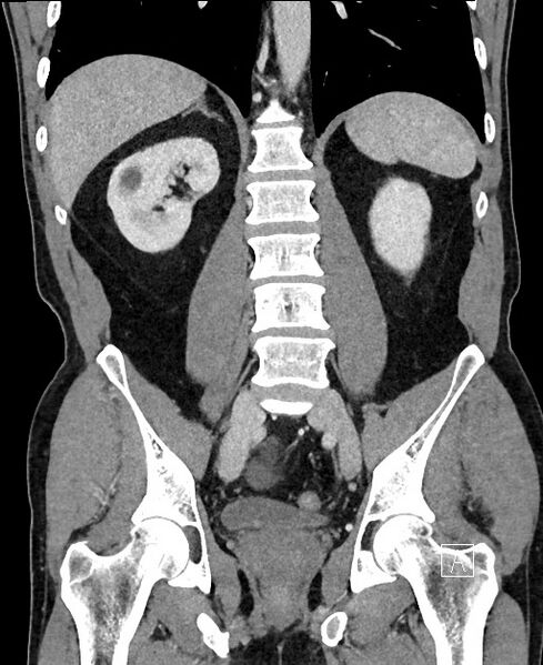 File:Closed loop small bowel obstruction - internal hernia (Radiopaedia 57806-64778 A 76).jpg