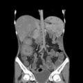 Colocolic fistula - Crohn disease (Radiopaedia 57063-63955 B 21).jpg