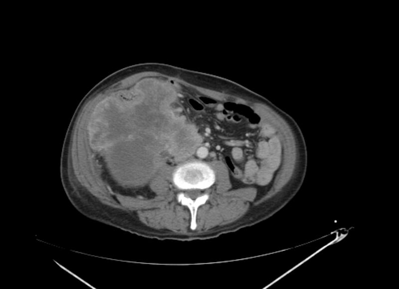 File:Colon cancer mimicking renal cell carcinoma (Radiopaedia 28986-29335 C 42).jpg