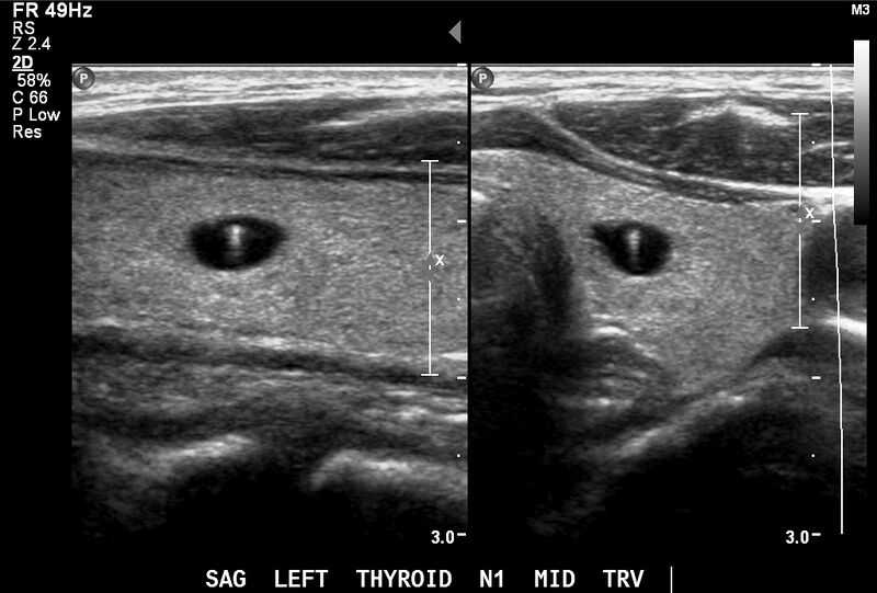File:Inspissated colloid in a thyroid nodule (Radiopaedia 52418).jpg