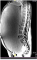 MRI giant serous cystadenoma of ovary