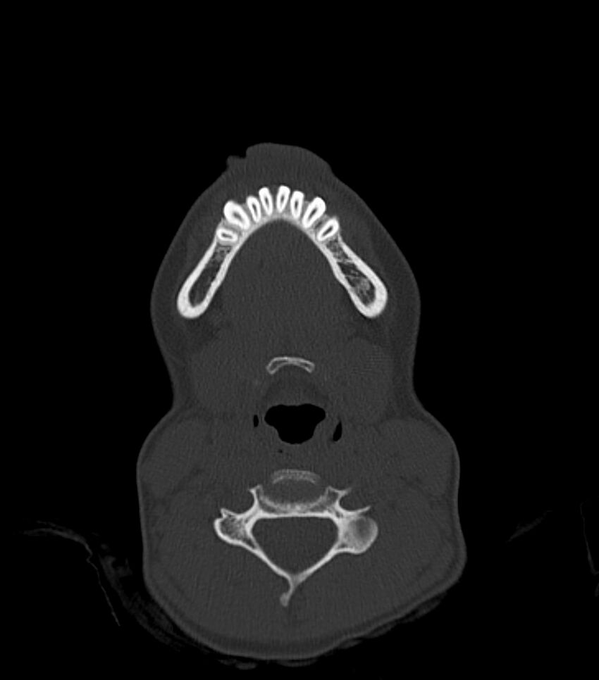 Nasoorbitoethmoid fracture (Radiopaedia 90044-107205 Axial bone window 23).jpg
